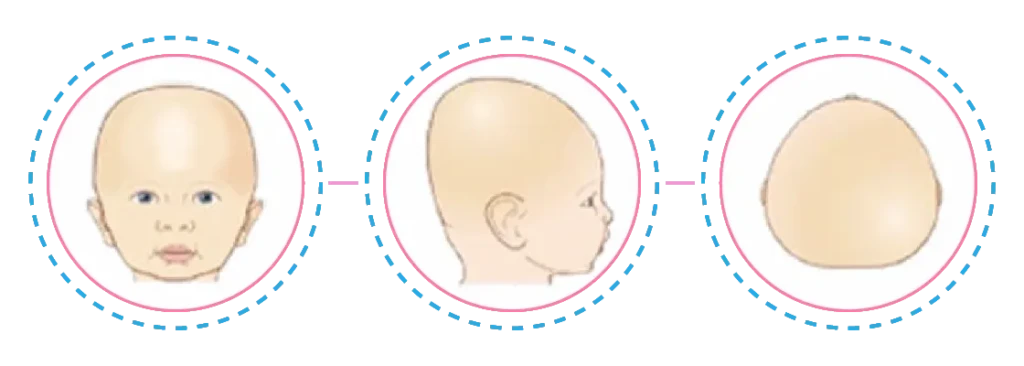 Fisioterapia Bebê | Assimetrias Cranianas | Braquicefalia Posicional