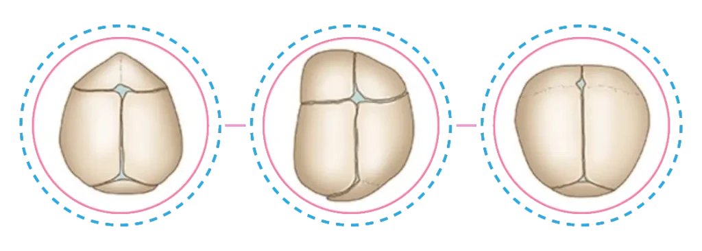 Fisioterapia Bebê | Assimetrias Cranianas | Craniossistenose Exemplos