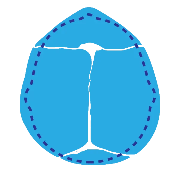 Fisioterapia Bebê | Assimetrias Cranianas | Craniossistenose