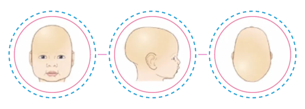 Fisioterapia Bebê | Assimetrias Cranianas | Escafocefalia Exemplos
