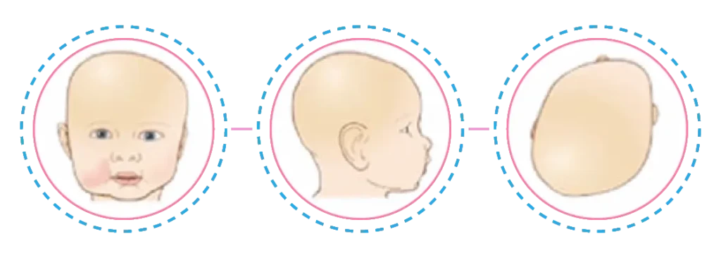Fisioterapia Bebê | Assimetrias Cranianas | Plagiocefalia Posicional