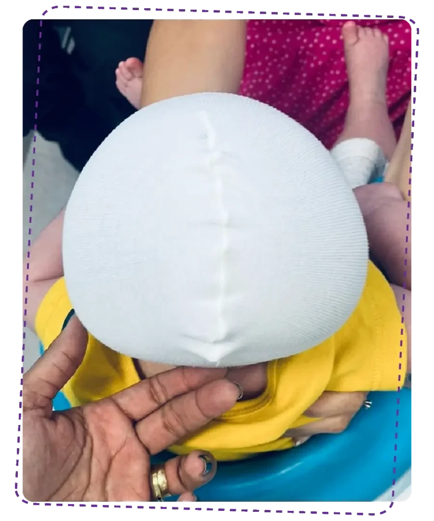 Fisioterapia Bebê | Capacetes 3D | Antes