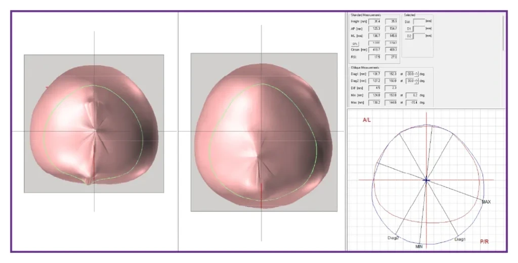 Fisioterapia Bebê | Capacetes 3D | Antes e Depois