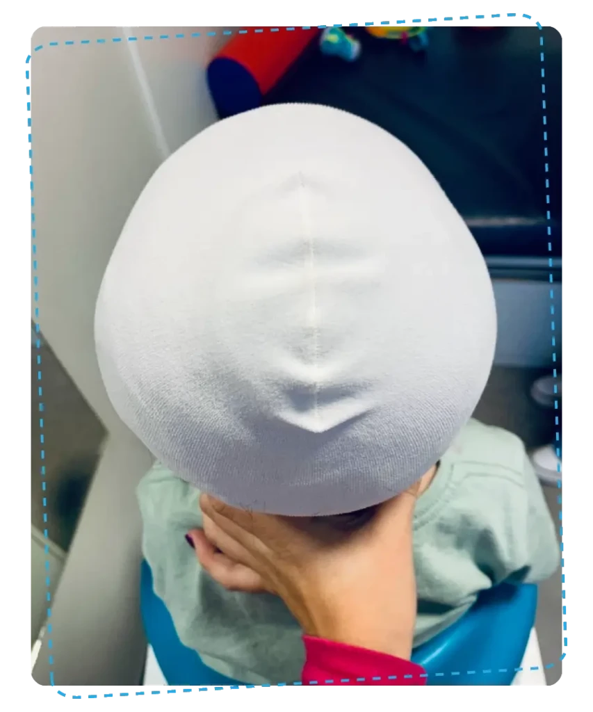 Fisioterapia Bebê | Capacetes 3D | Depois